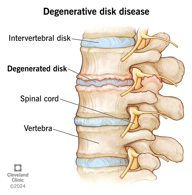 Degenerative Disc Disease